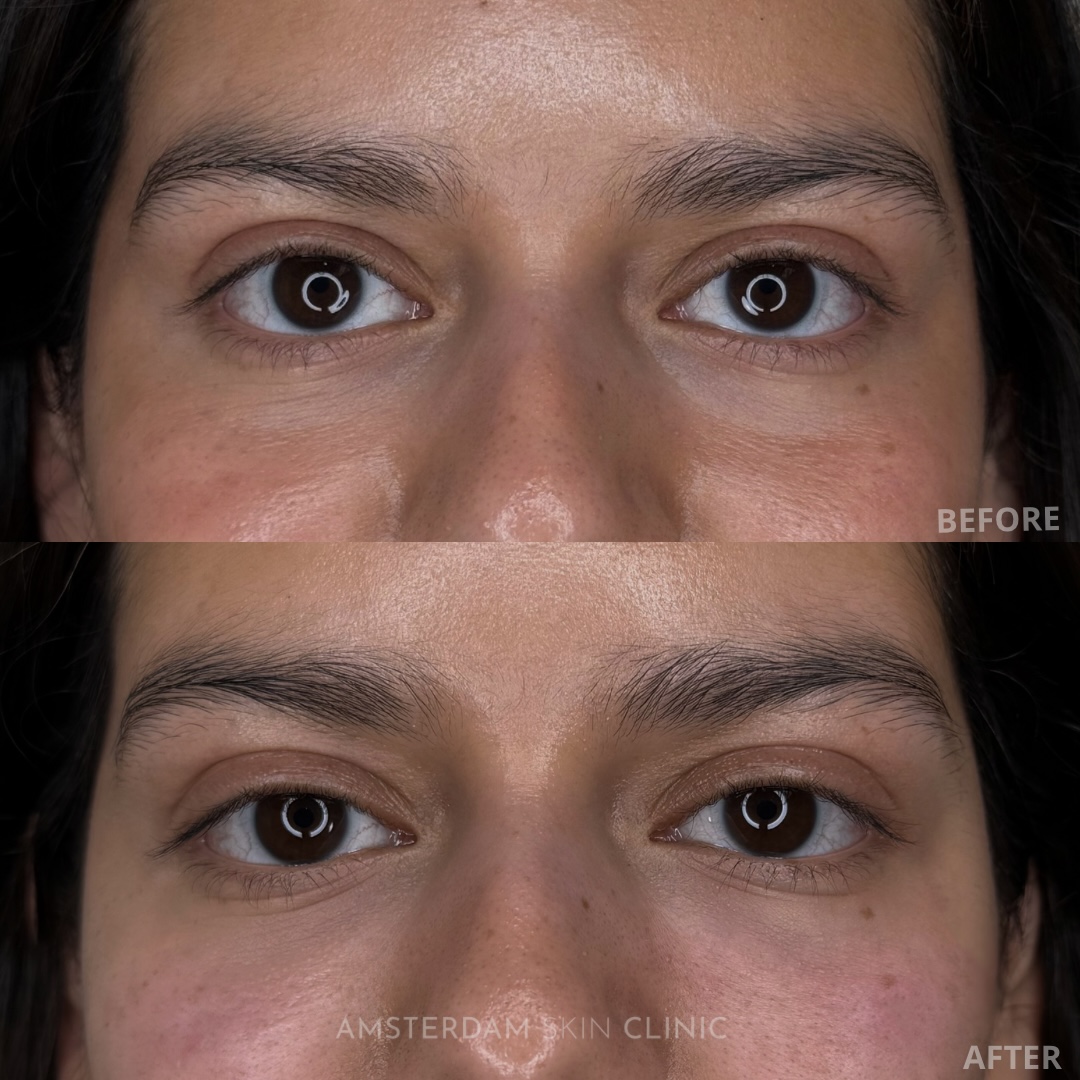 Wallen onder ogen voor en na