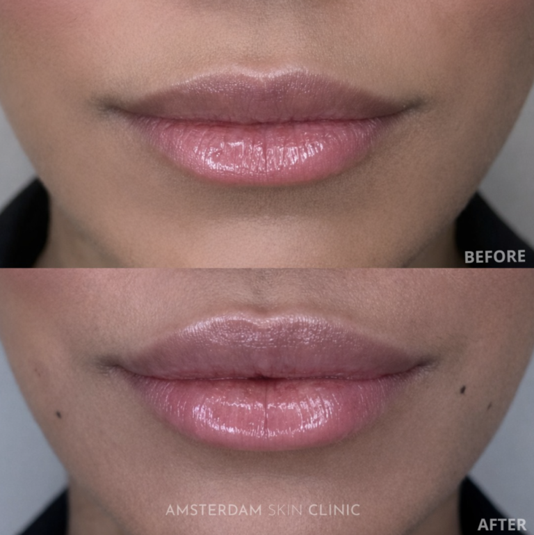 before-after lip filler
