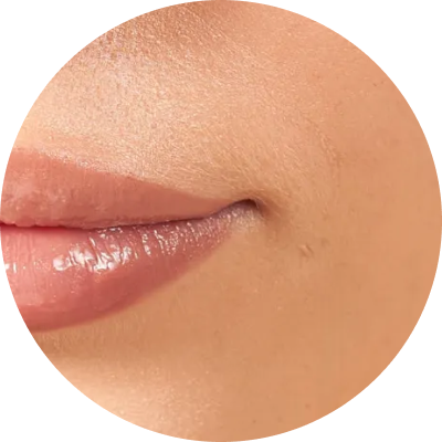 Mondhoeken liften met botox