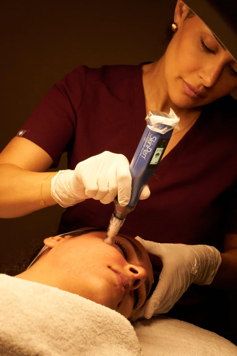 Microneedling met de SkinPen