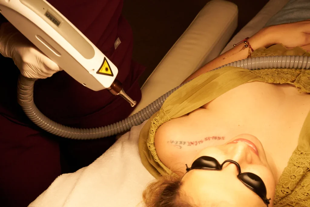 Tattoo verwijderen met de laser