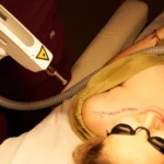 Tattoo verwijderen met de laser